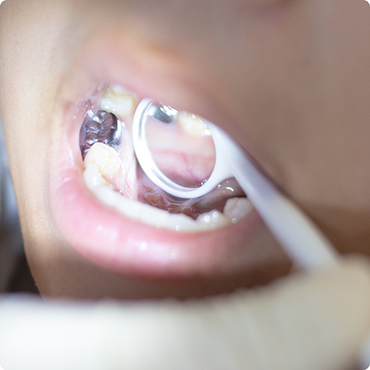 Open mouth with a metal restoration