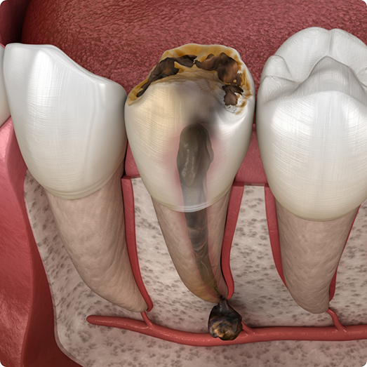 Illustration of a badly decayed tooth