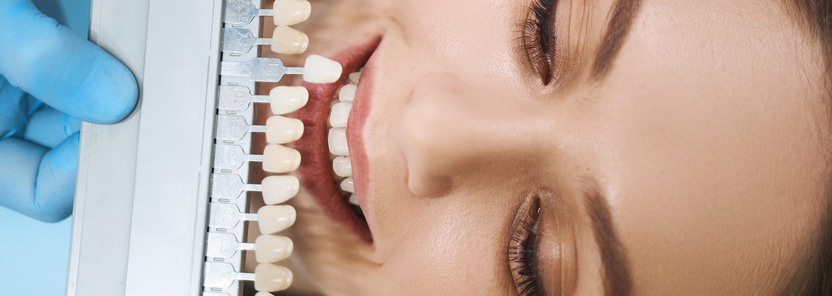 Close up of a patient having teeth shade matched for cosmetic dentistry in Fredericksburg
