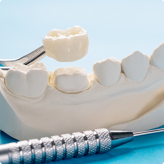 Metal free crown being lifted off model of teeth
