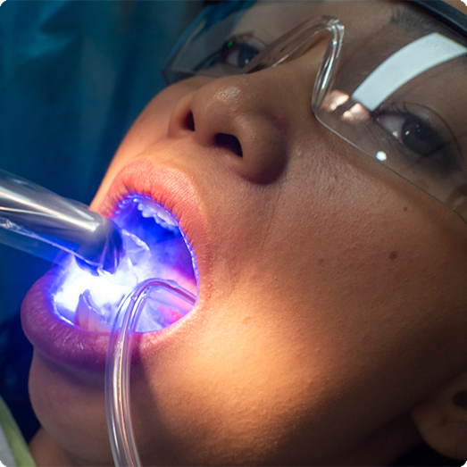 Close up of patient during dental bonding