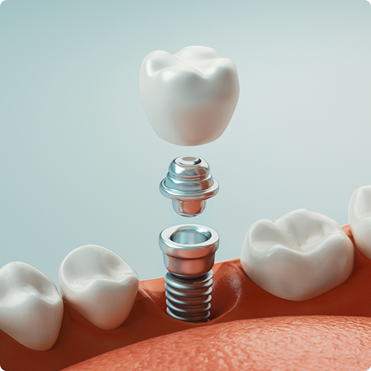 Illustration of crown and abutment being attached to dental implants