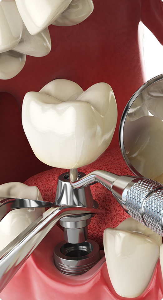 Illustration of dental crown being placed on an implant post