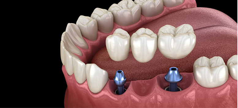 Illustration of a dental bridge being attached to two implant posts