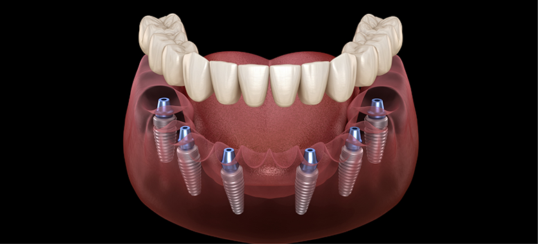 Illustration of dentures being attached to dental implants
