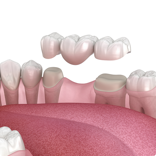Illustration of dental bridge for lower arch