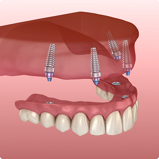 Illustration of dentures being attached to dental implants in upper arch