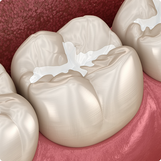 Illustration of teeth with white fillings