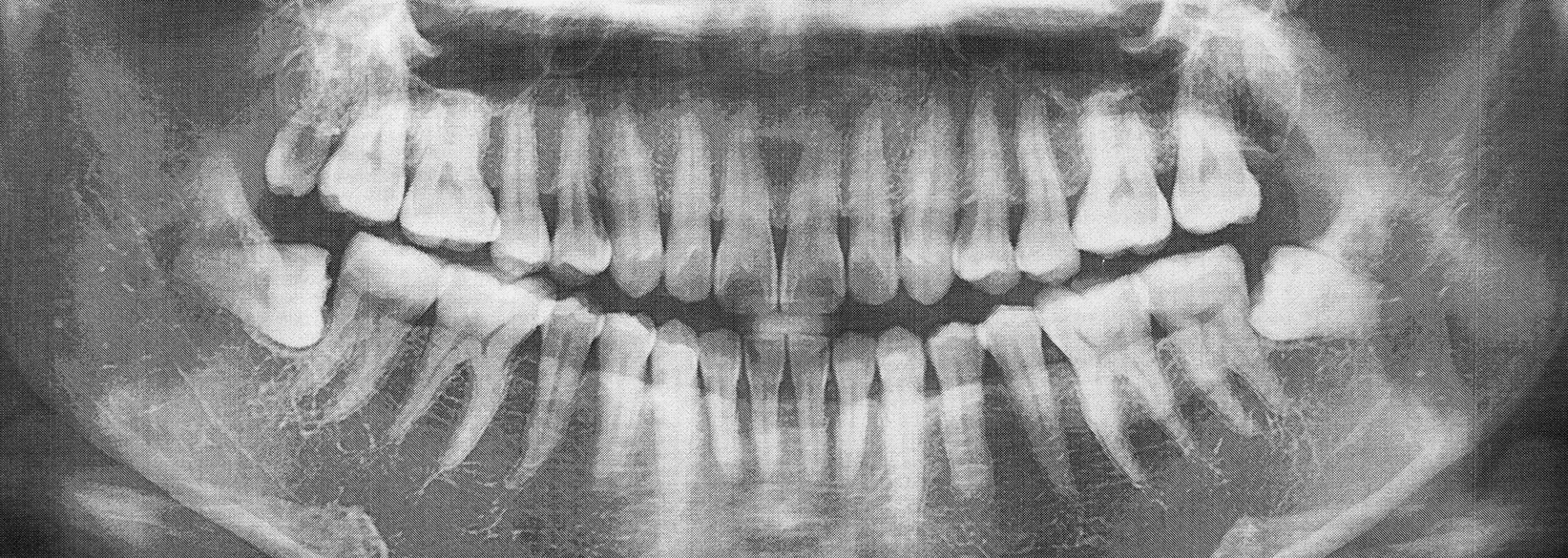 X ray showing impacted wisdom teeth